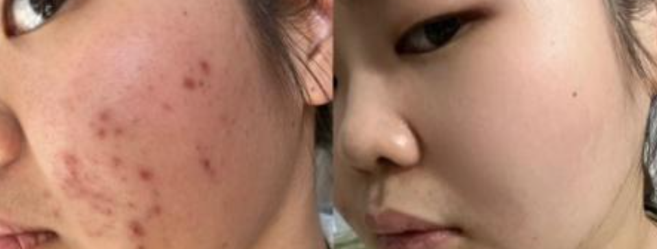 Wie erfolgt die Behandlung von Aknegrübchen und Akneflecken mit dem Punktlaser?