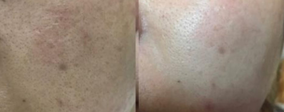 Wie erfolgt die Behandlung von Aknegrübchen und Akneflecken mit dem Punktlaser?